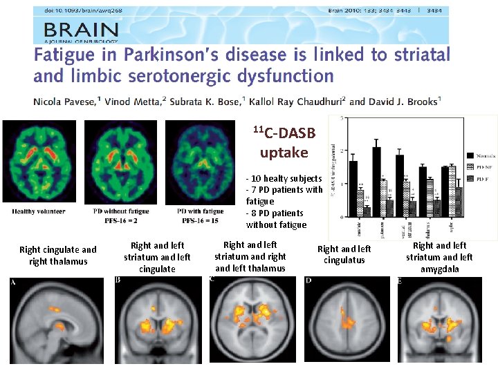 11 C-DASB uptake - 10 healty subjects - 7 PD patients with fatigue -