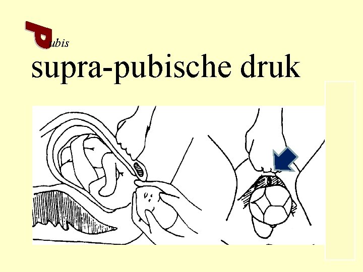 ubis supra-pubische druk 