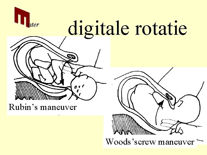 nter digitale rotatie Rubin’s maneuver Woods’screw maneuver 