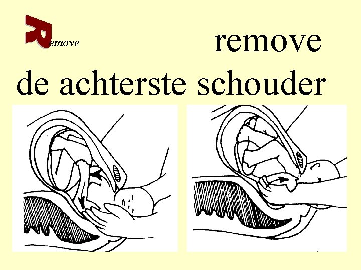 remove de achterste schouder emove 