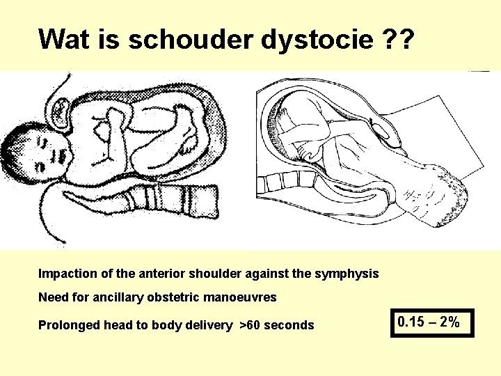 Wat is schouder dystocie ? ? Impaction of the anterior shoulder against the symphysis