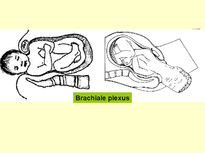 Brachiale plexus 