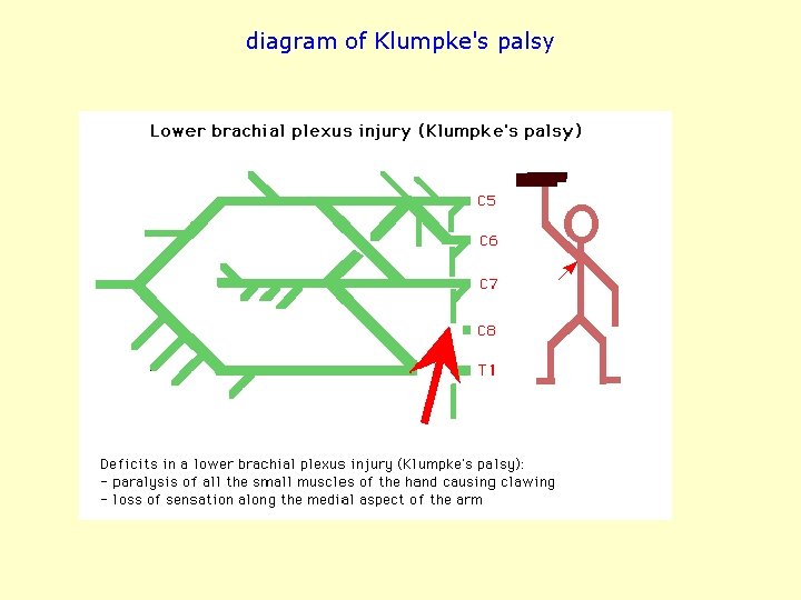 diagram of Klumpke's palsy 