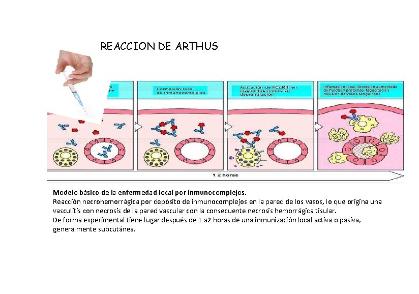 REACCION DE ARTHUS Modelo básico de la enfermedad local por inmunocomplejos. Reacción necrohemorrágica por