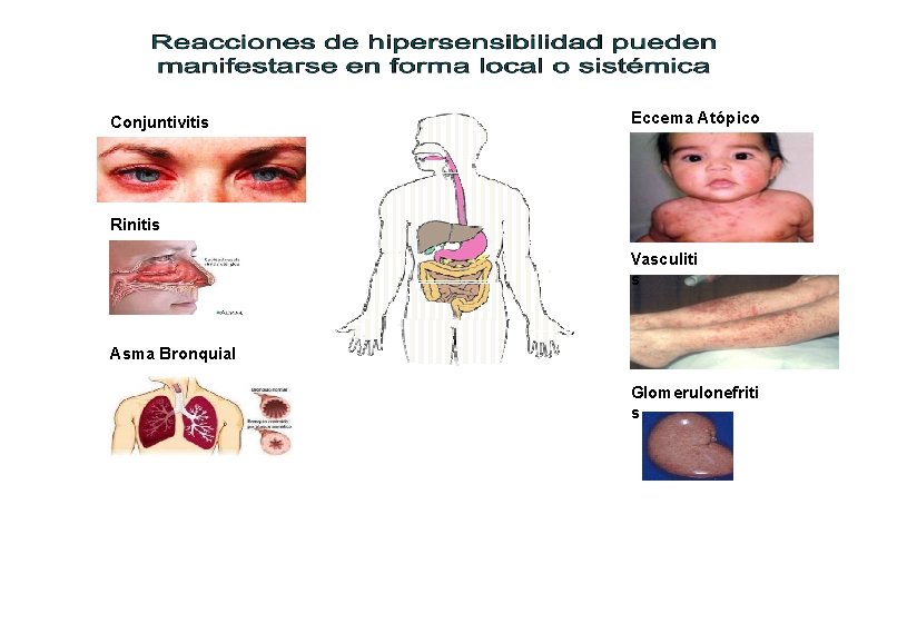 Conjuntivitis Eccema Atópico Rinitis Vasculiti s Asma Bronquial Glomerulonefriti s 