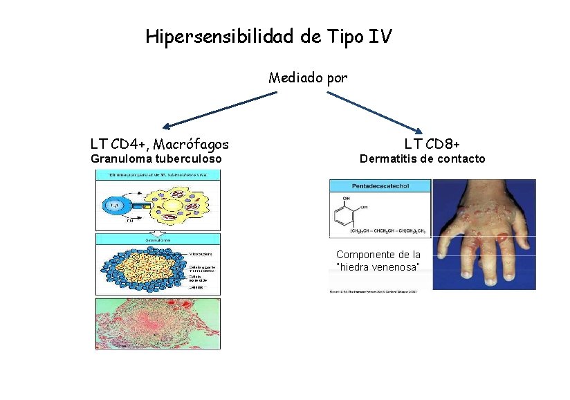 Hipersensibilidad de Tipo IV Mediado por LT CD 4+, Macrófagos Granuloma tuberculoso LT CD