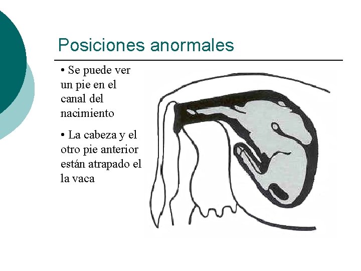 Posiciones anormales • Se puede ver un pie en el canal del nacimiento •