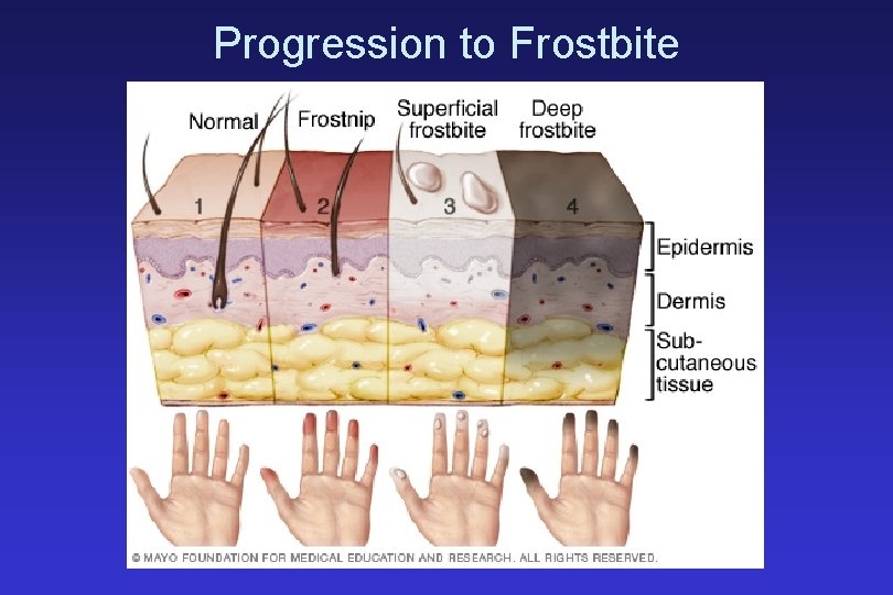 Progression to Frostbite 