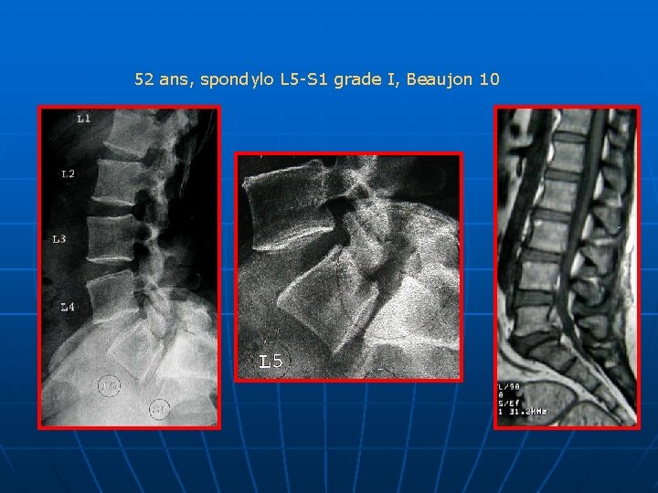 52 ans, spondylo L 5 -S 1 grade I, Beaujon 10 