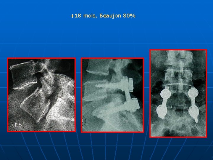 +18 mois, Beaujon 80% 