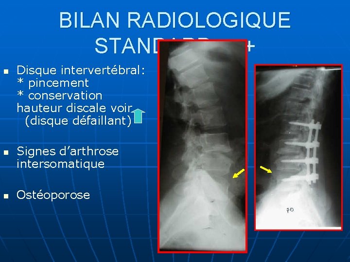 BILAN RADIOLOGIQUE STANDARD +++ n n n Disque intervertébral: * pincement * conservation hauteur