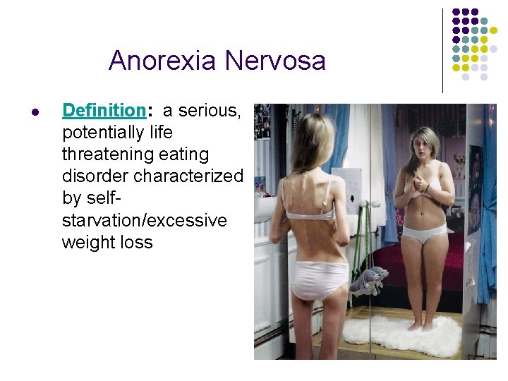 Anorexia Nervosa l Definition: a serious, potentially life threatening eating disorder characterized by selfstarvation/excessive