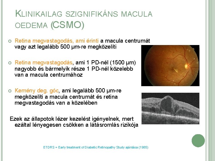 KLINIKAILAG SZIGNIFIKÁNS MACULA OEDEMA (CSMO) Retina megvastagodás, ami érinti a macula centrumát vagy azt KLINIKAILAG SZIGNIFIKÁNS MACULA OEDEMA (CSMO) Retina megvastagodás, ami érinti a macula centrumát vagy azt