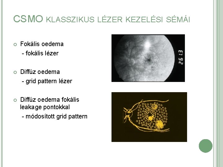 CSMO KLASSZIKUS LÉZER KEZELÉSI SÉMÁI Fokális oedema - fokális lézer Diffúz oedema - grid CSMO KLASSZIKUS LÉZER KEZELÉSI SÉMÁI Fokális oedema - fokális lézer Diffúz oedema - grid