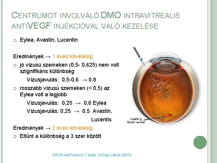 CENTRUMOT INVOLVÁLÓ DMO INTRAVITREALIS ANTIVEGF INJEKCIÓVAL VALÓ KEZELÉSE Eylea, Avastin, Lucentin Eredmények → 1 CENTRUMOT INVOLVÁLÓ DMO INTRAVITREALIS ANTIVEGF INJEKCIÓVAL VALÓ KEZELÉSE Eylea, Avastin, Lucentin Eredmények → 1