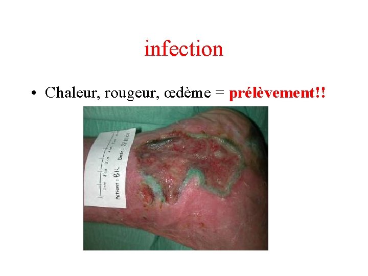 infection • Chaleur, rougeur, œdème = prélèvement!! 