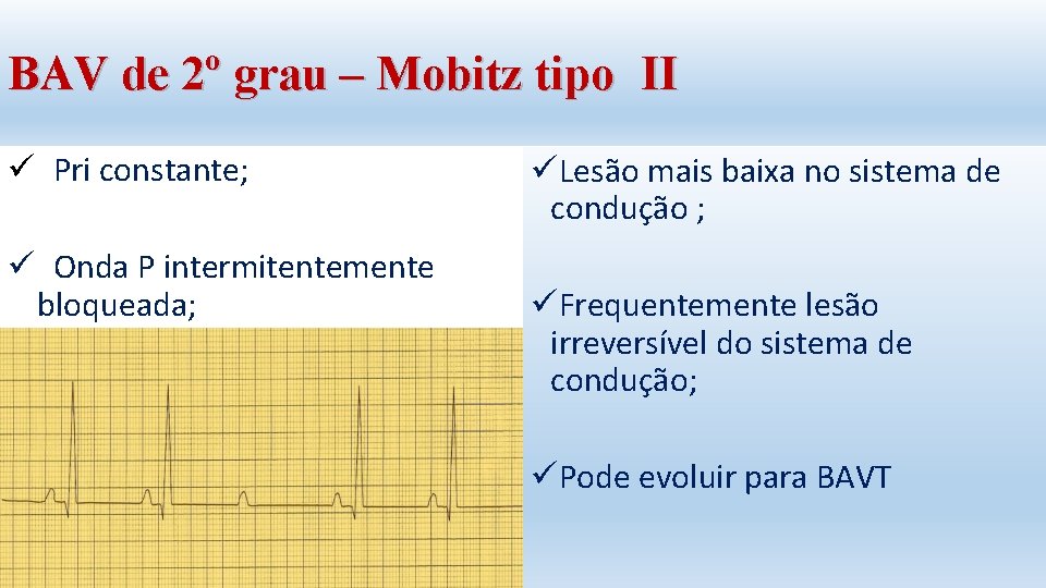 BAV de 2º grau – Mobitz tipo II ü Pri constante; ü Onda P