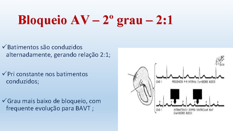 Bloqueio AV – 2º grau – 2: 1 üBatimentos são conduzidos alternadamente, gerando relação