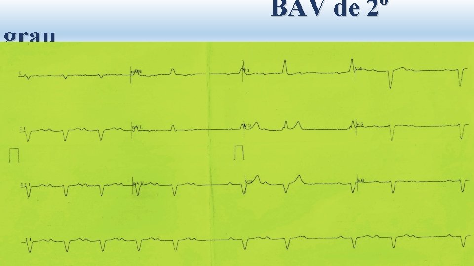 grau BAV de 2º 