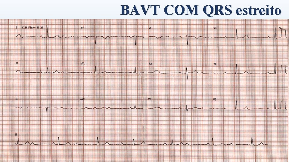 BAVT COM QRS estreito 