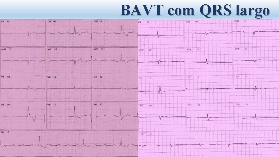 BAVT com QRS largo 