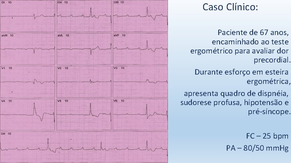 Caso Clínico: Paciente de 67 anos, encaminhado ao teste ergométrico para avaliar dor precordial.