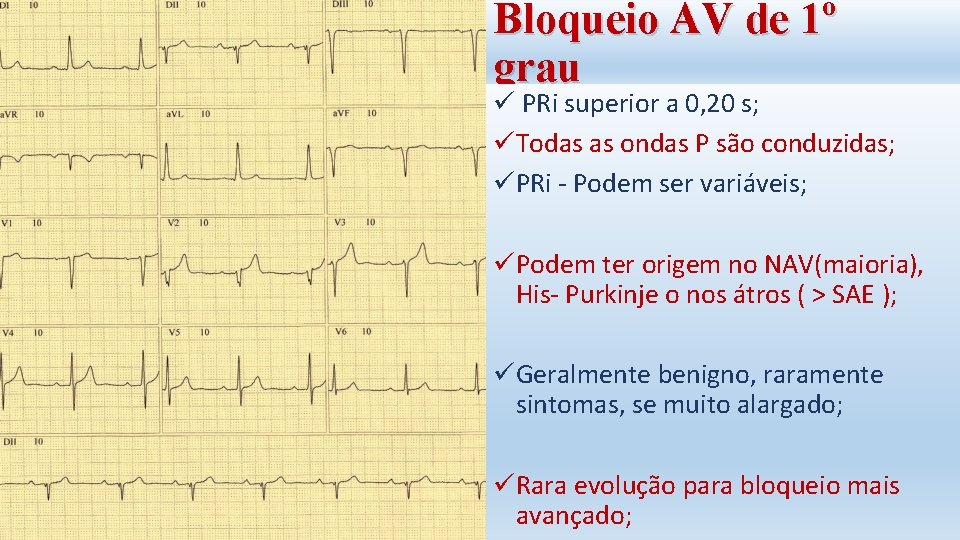 Bloqueio AV de 1º grau ü PRi superior a 0, 20 s; üTodas as