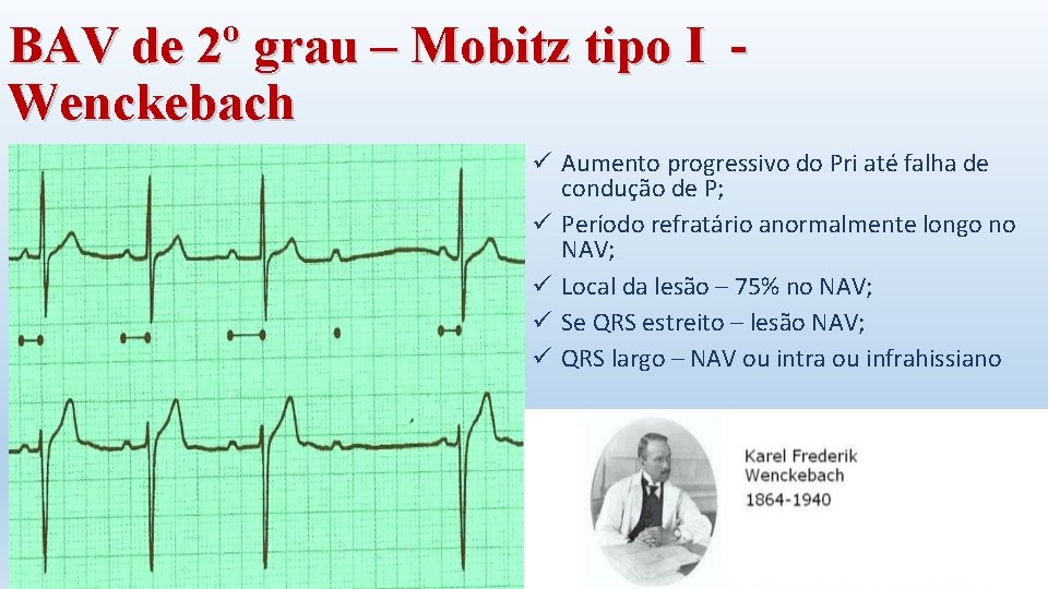 BAV de 2º grau – Mobitz tipo I Wenckebach ü Aumento progressivo do Pri