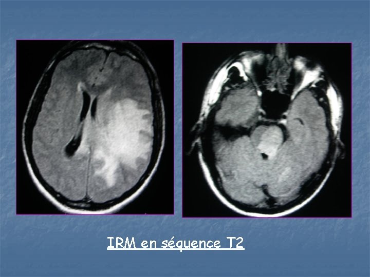 IRM en séquence T 2 