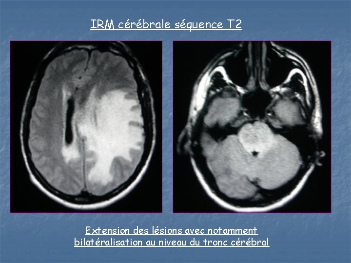 IRM cérébrale séquence T 2 Extension des lésions avec notamment bilatéralisation au niveau du