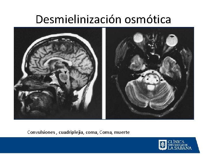 Desmielinización osmótica Convulsiones , cuadriplejia, coma, Coma, muerte 