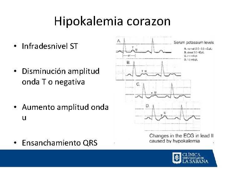 Hipokalemia corazon • Infradesnivel ST • Disminución amplitud onda T o negativa • Aumento
