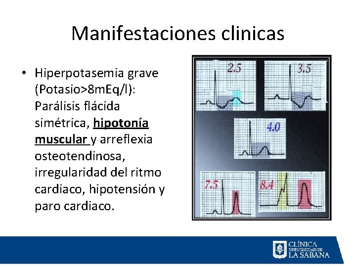 Manifestaciones clinicas • Hiperpotasemia grave (Potasio>8 m. Eq/l): Parálisis flácida simétrica, hipotonía muscular y