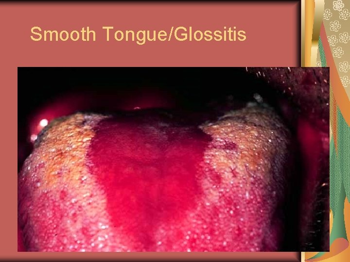 Smooth Tongue/Glossitis 