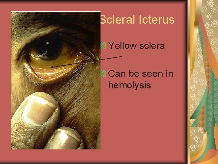 Scleral Icterus Yellow sclera Can be seen in hemolysis 