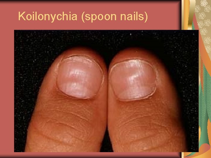 Koilonychia (spoon nails) 