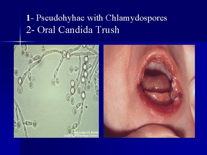 1 - Pseudohyhae with Chlamydospores 2 - Oral Candida Trush 