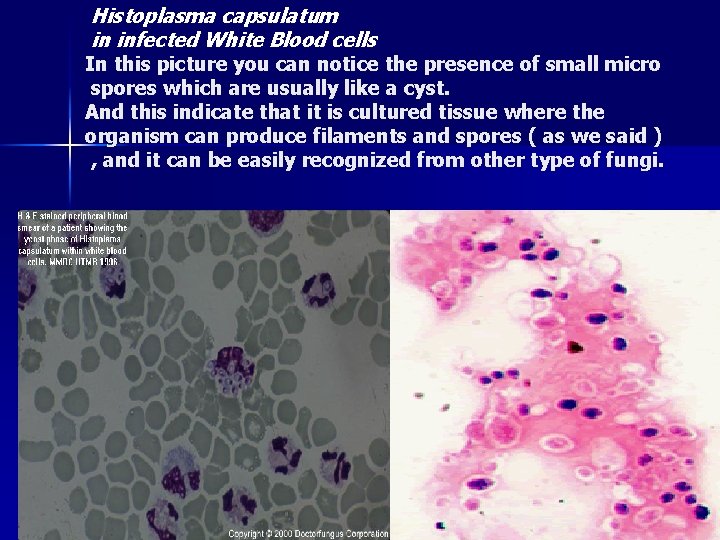 Histoplasma capsulatum in infected White Blood cells In this picture you can notice the