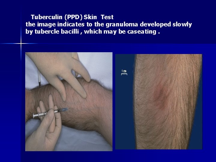  Tuberculin (PPD) Skin Test the image indicates to the granuloma developed slowly by