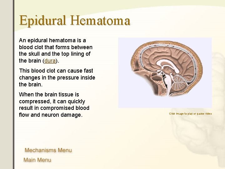 Epidural Hematoma An epidural hematoma is a blood clot that forms between the skull