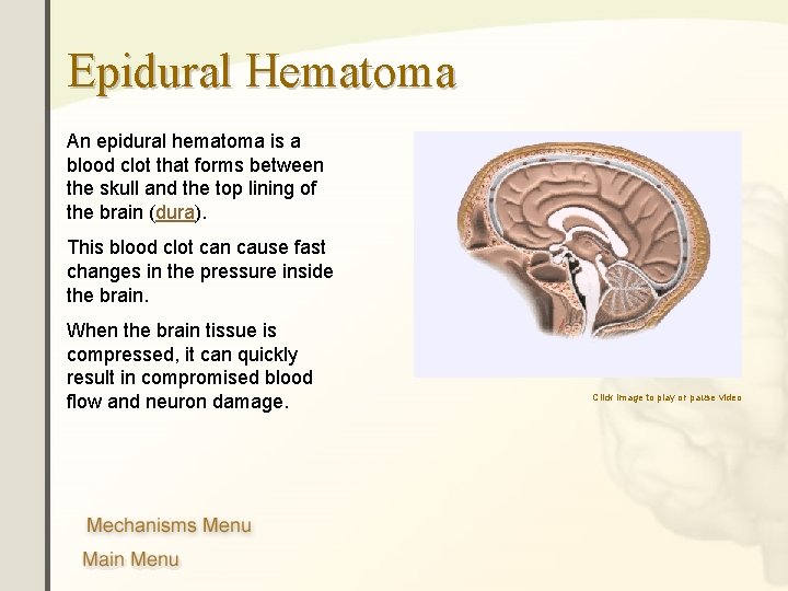 Epidural Hematoma An epidural hematoma is a blood clot that forms between the skull Epidural Hematoma An epidural hematoma is a blood clot that forms between the skull