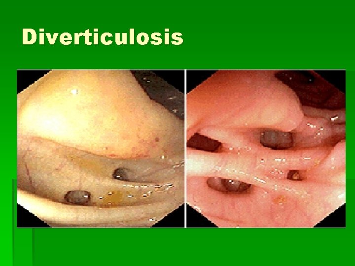 Diverticulosis 