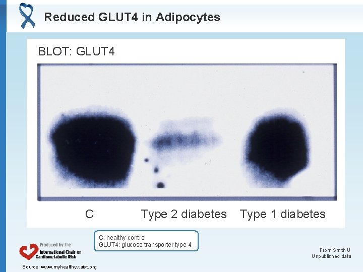 Reduced GLUT 4 in Adipocytes BLOT: GLUT 4 C Type 2 diabetes C: healthy