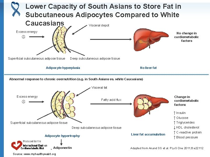 Lower Capacity of South Asians to Store Fat in Subcutaneous Adipocytes Compared to White