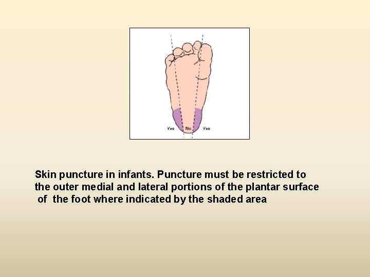 Skin puncture in infants. Puncture must be restricted to the outer medial and lateral