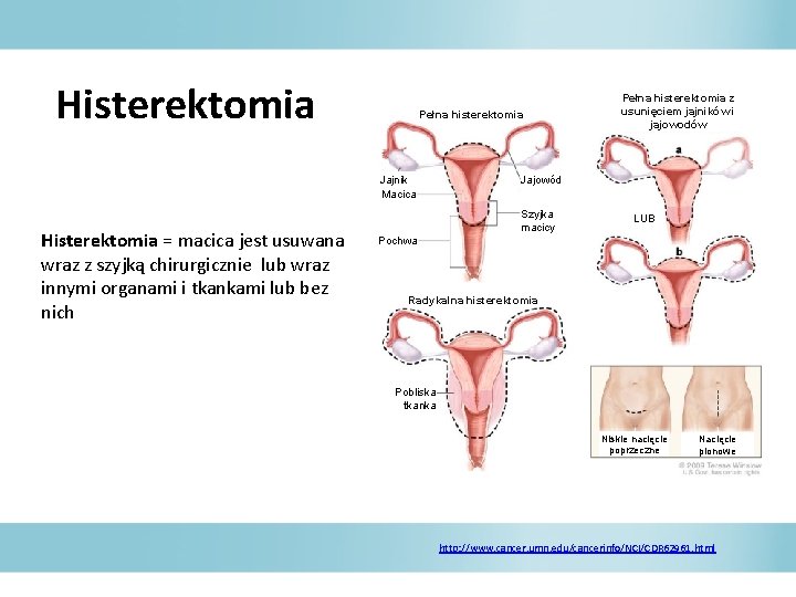 Histerektomia Pełna histerektomia Jajnik Macica Histerektomia = macica jest usuwana wraz z szyjką chirurgicznie