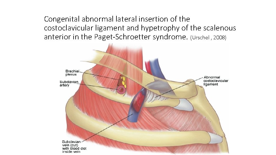 Congenital abnormal lateral insertion of the costoclavicular ligament and hypetrophy of the scalenous anterior