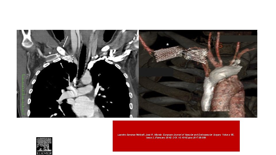 Leandro Barreras Molinelli, José N. Allende European Journal of Vascular and Endovascular Surgery Volume