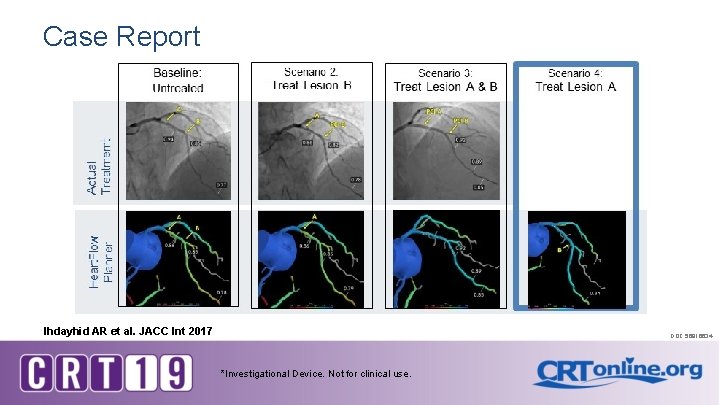 Case Report Ihdayhid AR et al. JACC Int 2017 DOC 56816634 *Investigational Device. Not