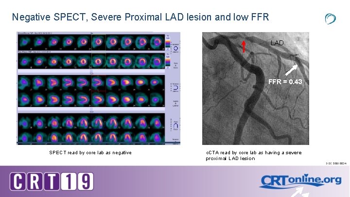 Negative SPECT, Severe Proximal LAD lesion and low FFR LAD FFR = 0. 43